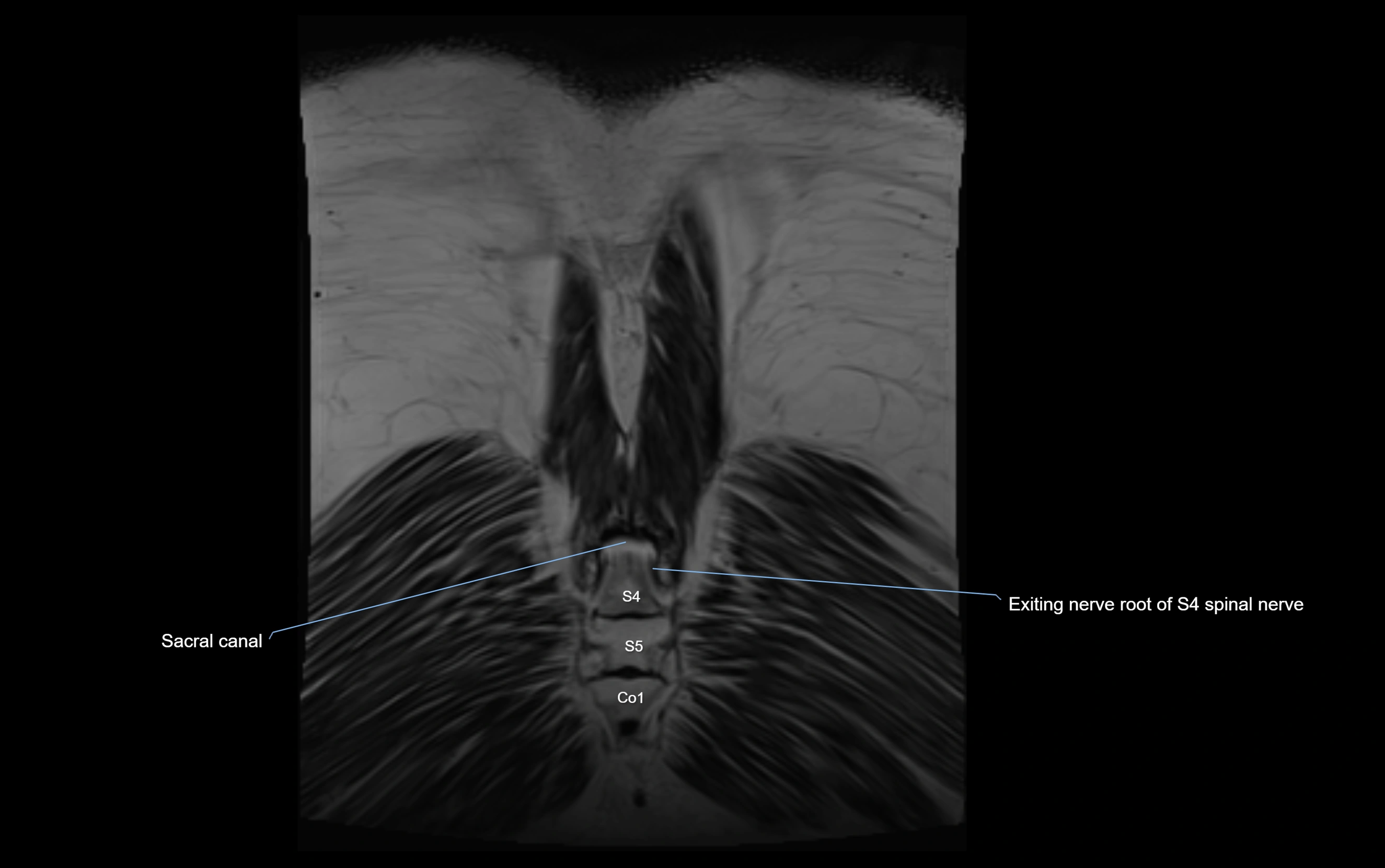 MR lumbosacral plexus cross sectional anatomy 3T  radiology  image-img-09001-00083.webp